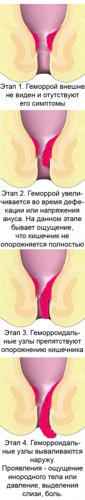 геморрой.jpg