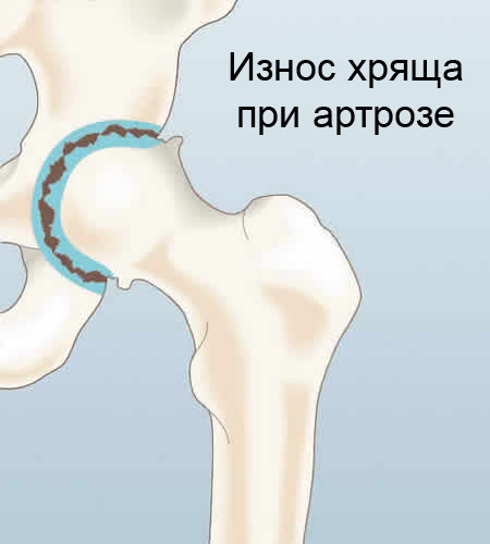 Износ хряща при артрозе.jpg